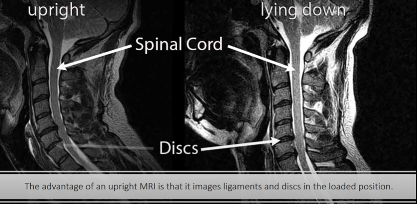 upright MRI vs lying down