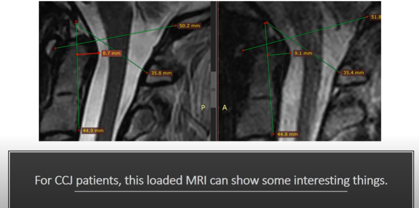 The upright MRI can show interesting things for CCJ patients