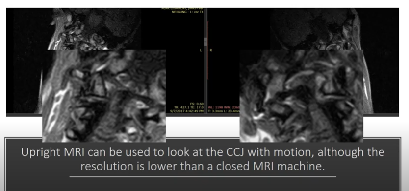 The quality of the imaging for upright MRI is lower than the standard MRI