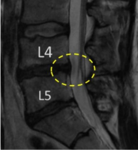 After MRI - Perc-FSU - The Trusted Alternative to Spinal Fusion