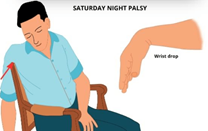 wrist drop is a common presentation of radial nerve palsy