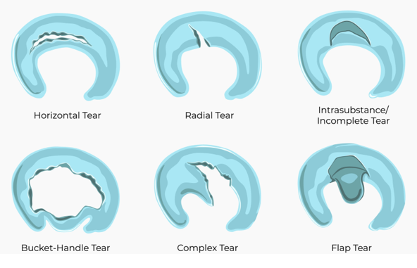 types of meniscus tears