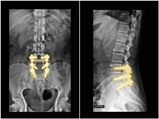 Posterior Lumbar Interbody Fusion vs Transforaminal Lumbar Interbody Fusion