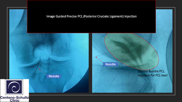 Understanding (PCL) Posterior Cruciate Ligament Injury