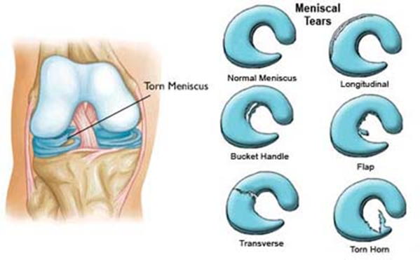 6 Meniscus Tear Types That You Need To Know About