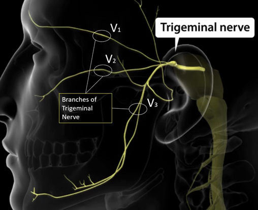 Trigeminal Neuralgia -compression of the trigeminal nerve