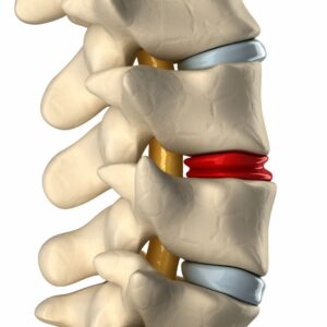 Thoracic Radiculopathy: Causes, Symptoms, Treatments