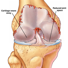 lateral joint compartment and outside knee pain