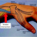 Intersection Syndrome: An Important Cause of Wrist Pain