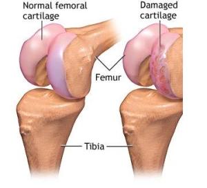 Normal and Damaged Knee Cartilage