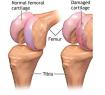knee-cartilage-23