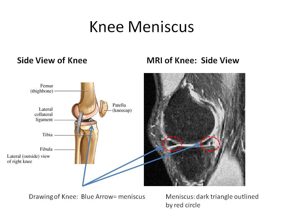 Knee Mensicus2