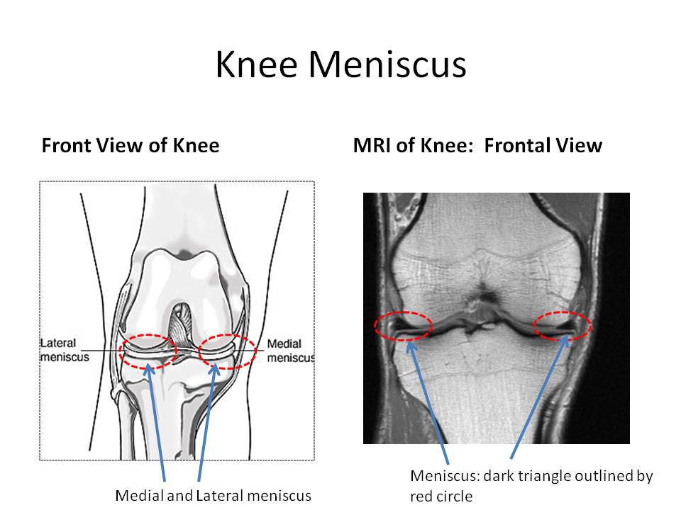 Knee Mensicus3