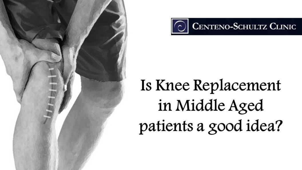 middle aged patients getting knee replacements