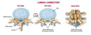 https://centenoschultz.com/wp-content/uploads/laminectomy-.-lumbar-300x117.jpg