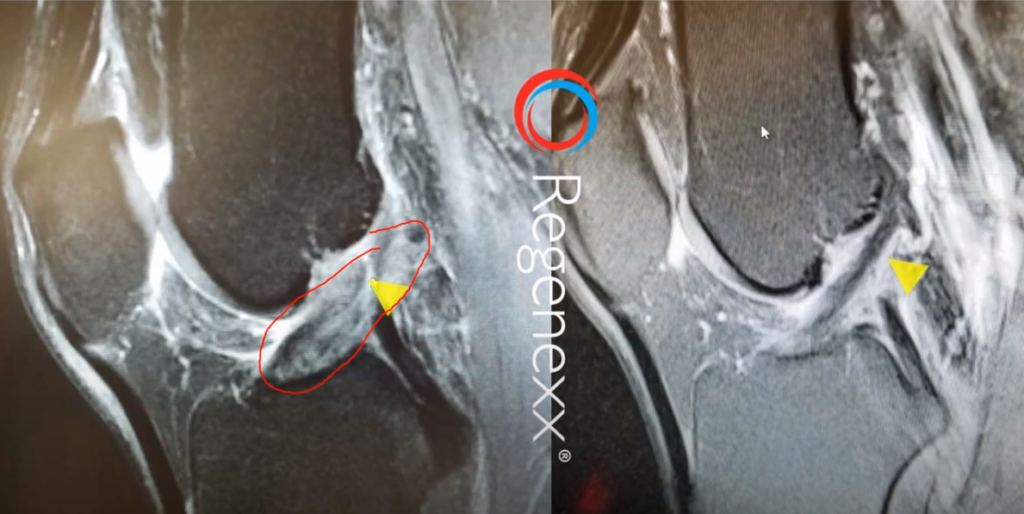 MRI of ACL before-and-after Regenexx stem cell procedure