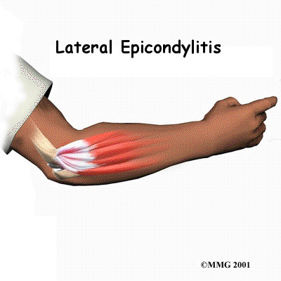 Lateral epicondyle 2