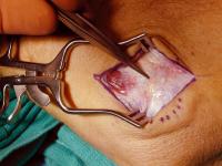 lateral-epidcondyle-surgery