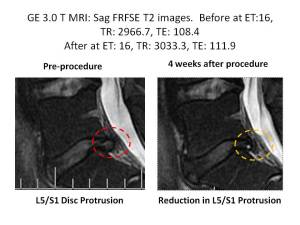 Stem Cell Therapy for Lumbar Disc Protrusions