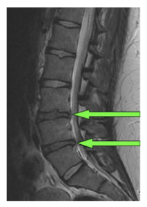 lumbar degenerative disc disease and discectomy