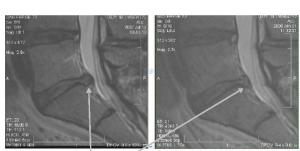 lumbar-disc8-regenexx1