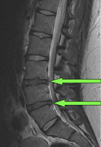 lumbar1