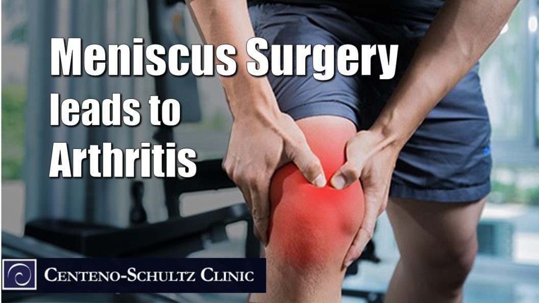 meniscus surgery knee arthritis