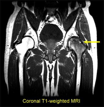 mri-avn-stage-iii