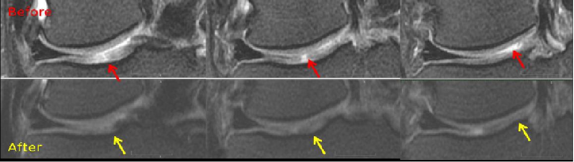 Knee Cartilage Before and After Regenexx Procedure