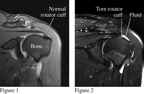 Does a Partial Rotator Cuff Tear Get Bigger Over Time? - Regenexx