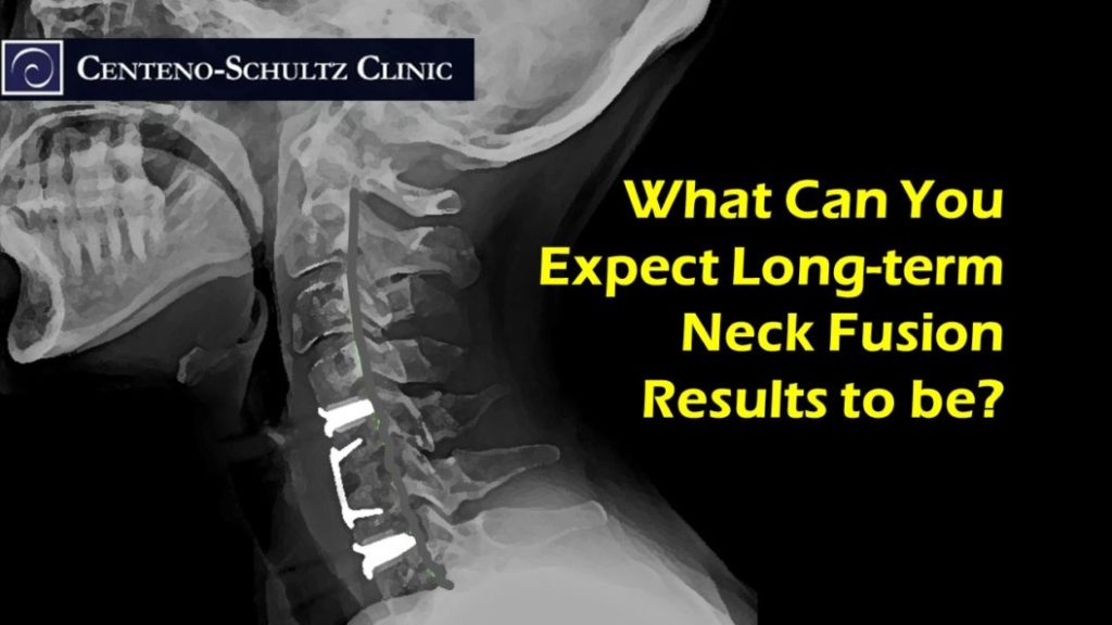 neck-fusion-may-be-creating-more-problems-than-it-solves