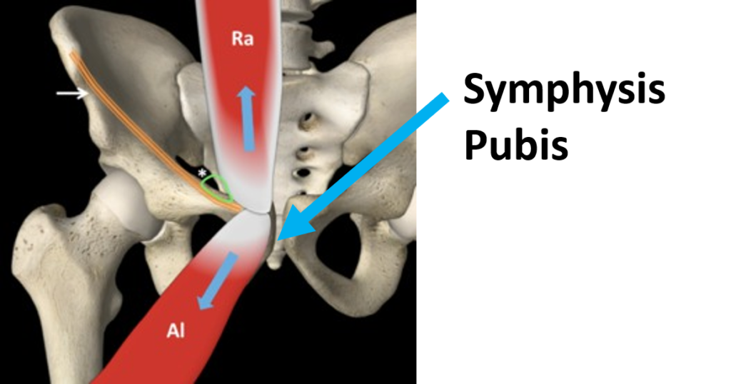 Osteitis Pubis: Causes, Symptoms, Treatment - CSC