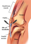 Pat_Tendonitis