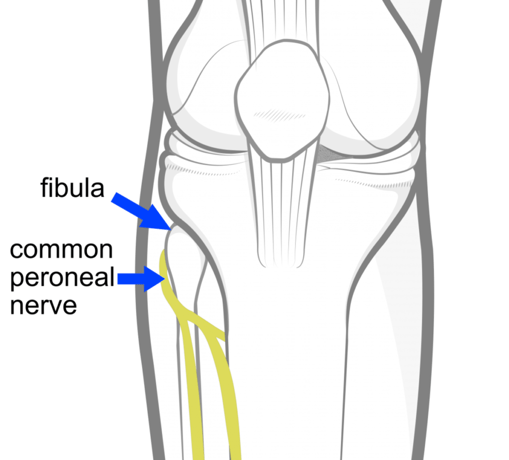 common peroneal nerve injury