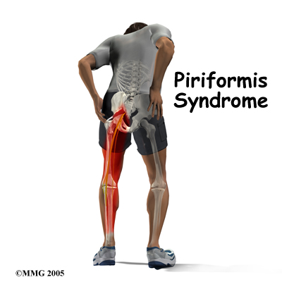 Piriformis Syndrome – What is it and how can Myotherapy and