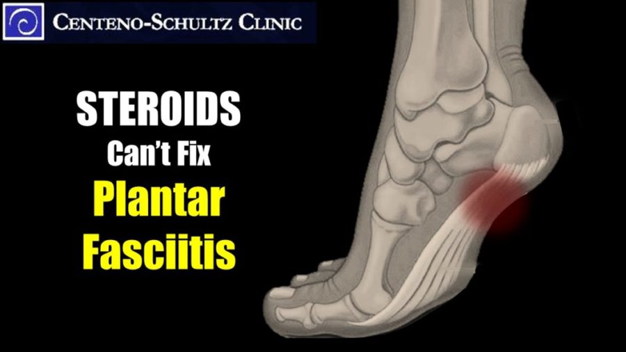 Plantar Fasciitis 3 Reasons Steroid Injections Are a Bad