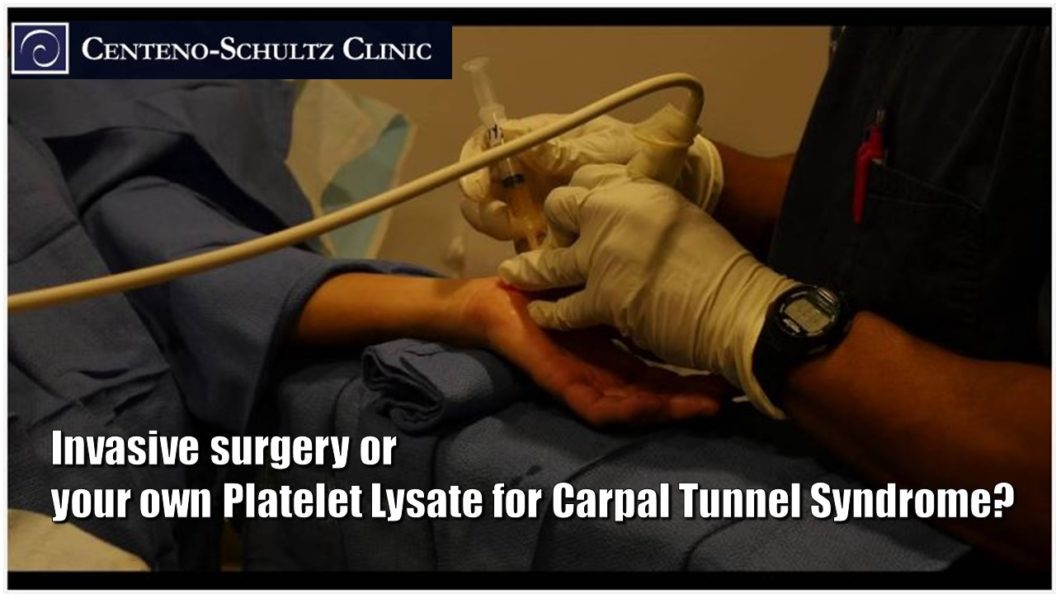 platelet lysate for carpal tunnel syndrome