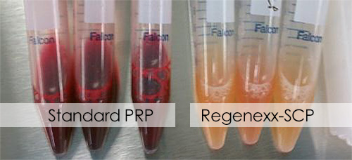 prp for pcl strains and tears