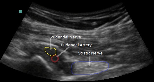 Why Pudendal Neuralgia is a Pain in the Butt