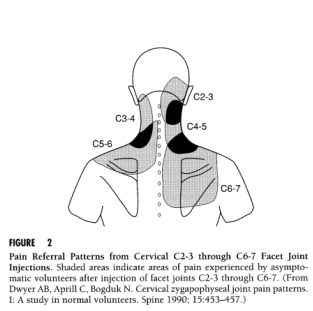 referral-pattern-of-cervical-facet