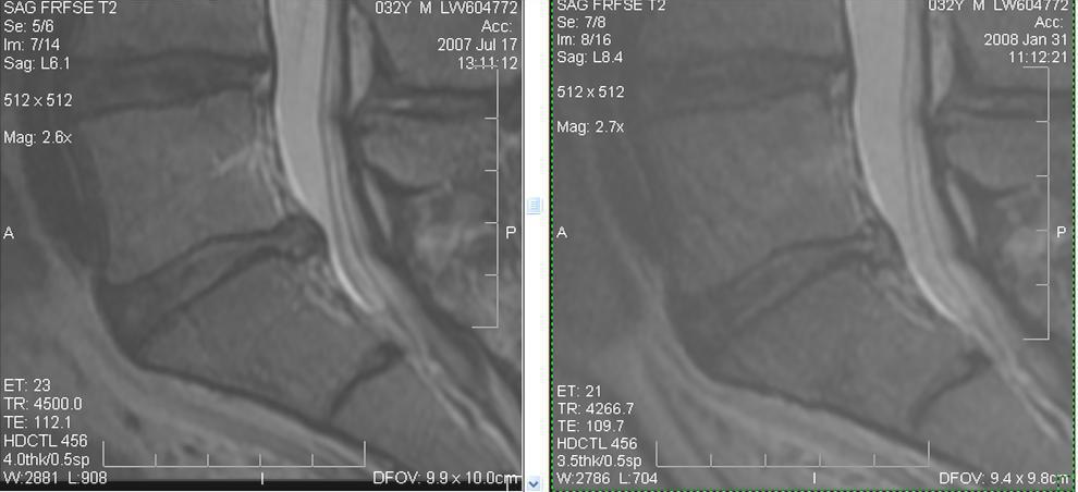 regenexx-lumbar-disc-info-patientonly-jpg3