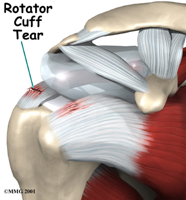 Rotator Cuff Tear - Orthopedic Specialists of Seattle