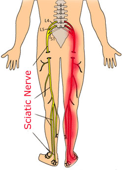 sciatic-nerve-illustration2