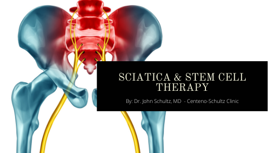 sciatica & stem cell therapy