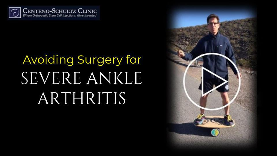 severe ankle arthritis