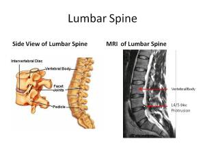 MRI Of Lumbar Spine: Stem Cell Therapy | Centeno-Schultz