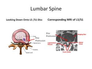 Low Back Pain Linked to Cells in Spinal “Shock Absorbers”