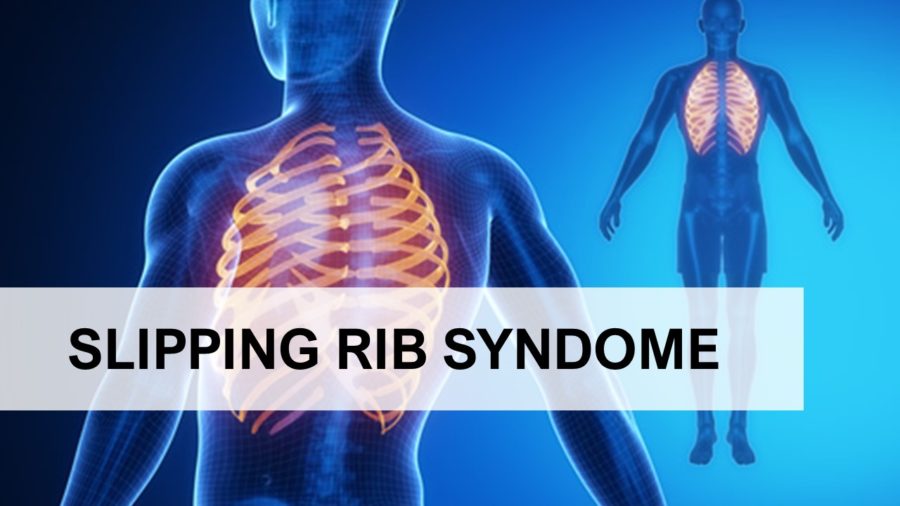 slipping rib syndrome
