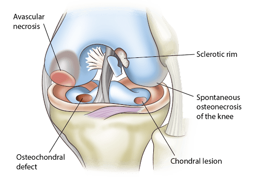 Spontaneous Osteonecrosis Of The Knee (SONK)