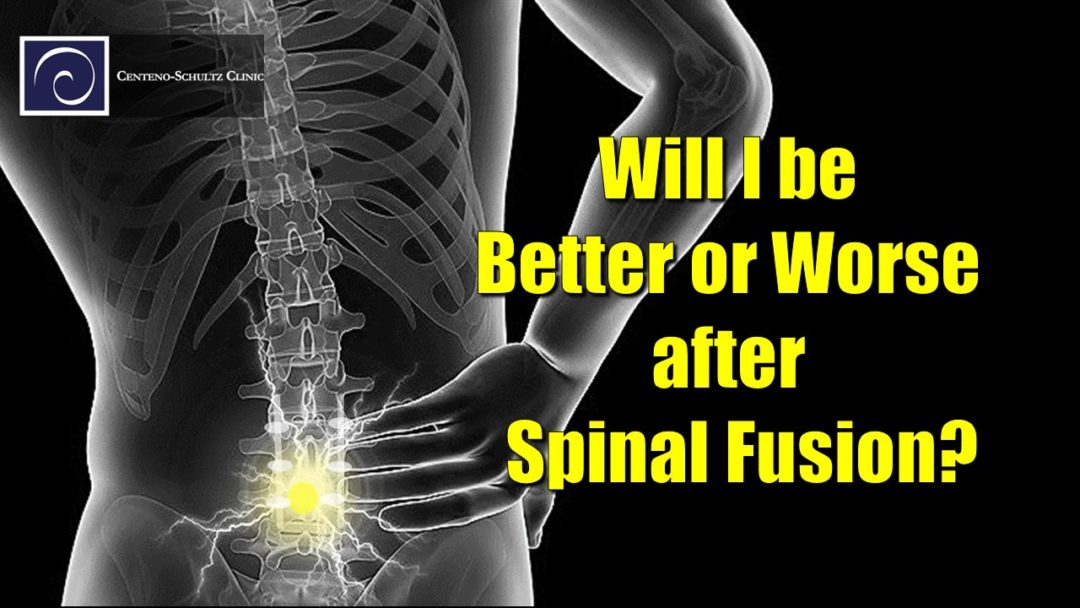 spinal fusion